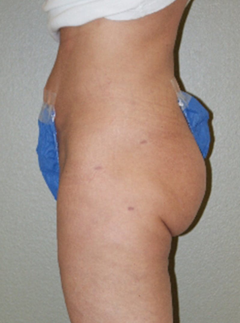 Liposuction Before & After Gallery - Patient 262222 - Image 4