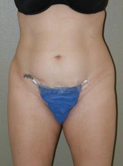 Liposuction Before & After Gallery - Patient 347526 - Image 1