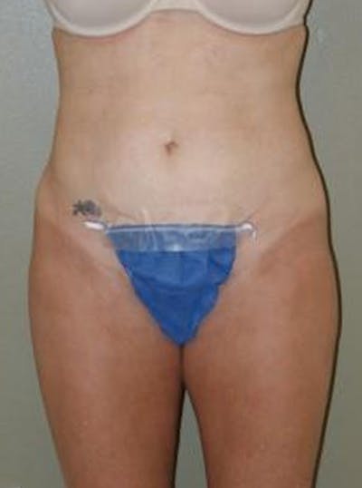 Liposuction Before & After Gallery - Patient 347526 - Image 2