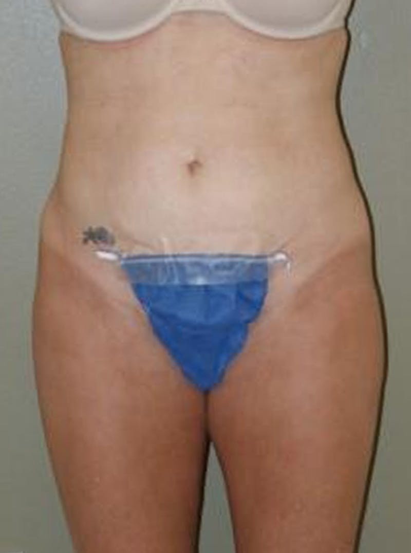 Liposuction Before & After Gallery - Patient 347526 - Image 2