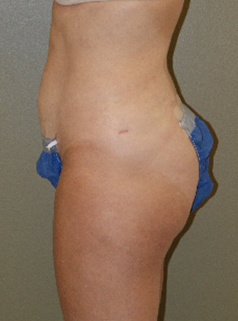 Liposuction Before & After Gallery - Patient 347526 - Image 4