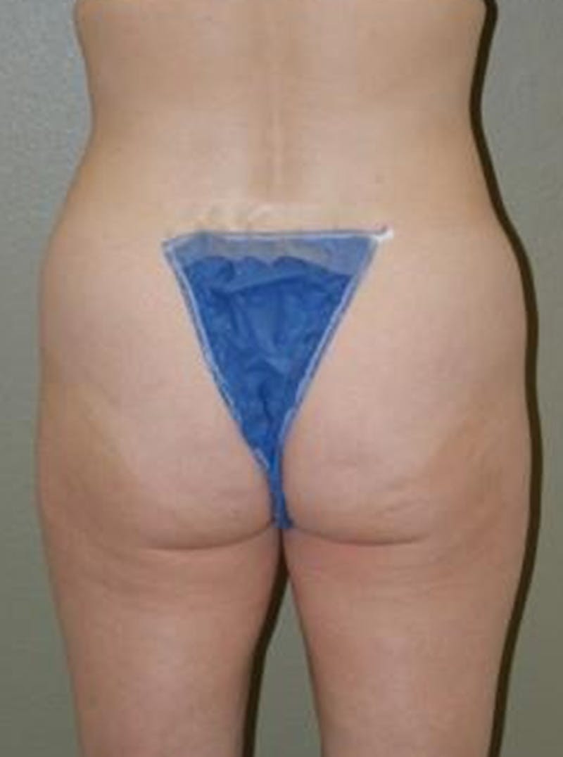 Liposuction Before & After Gallery - Patient 347526 - Image 5