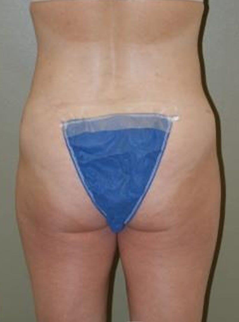 Liposuction Before & After Gallery - Patient 347526 - Image 6