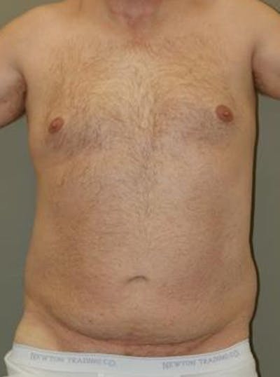 Liposuction Before & After Gallery - Patient 313431 - Image 1
