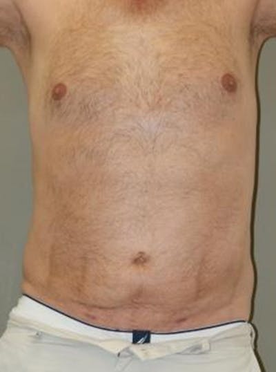 Liposuction Before & After Gallery - Patient 313431 - Image 2