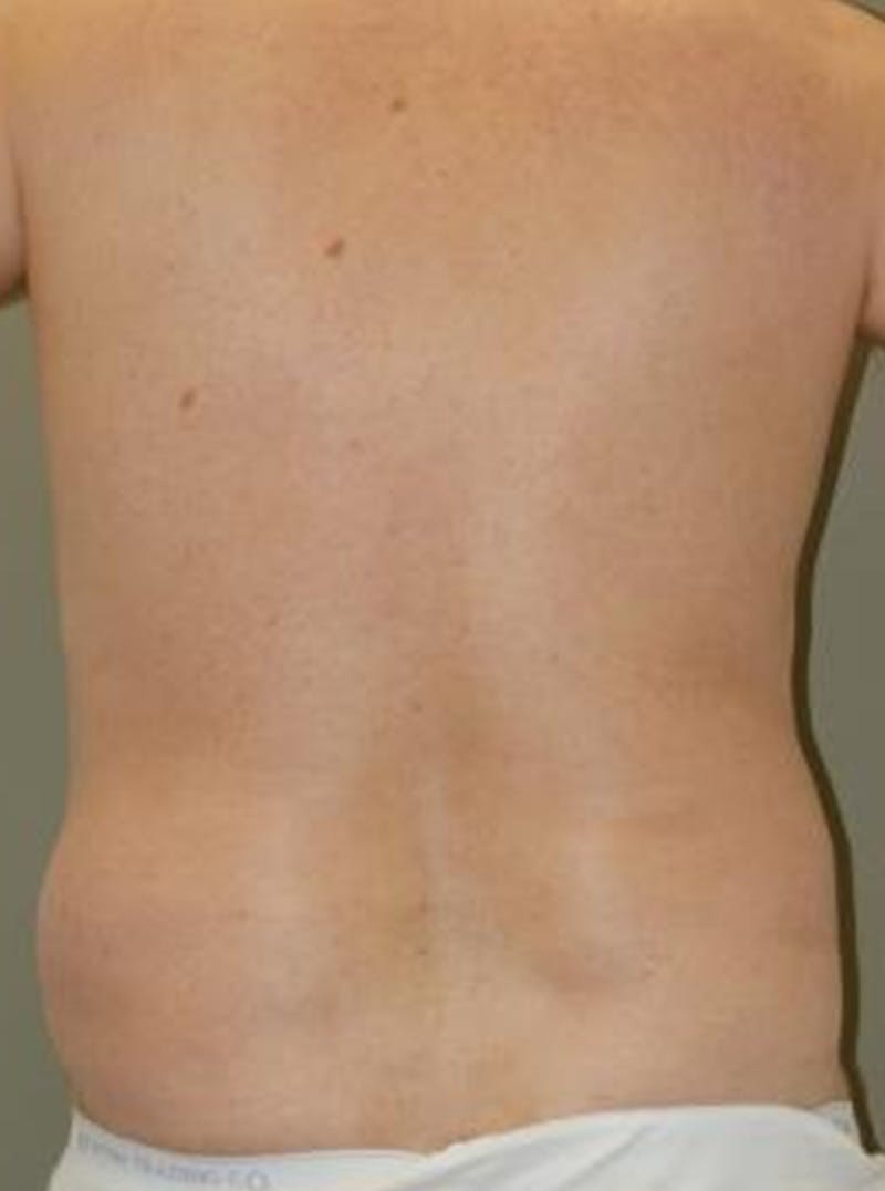 Liposuction Before & After Gallery - Patient 313431 - Image 3