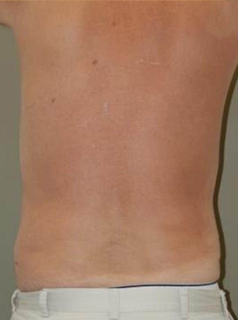 Liposuction Before & After Gallery - Patient 313431 - Image 4