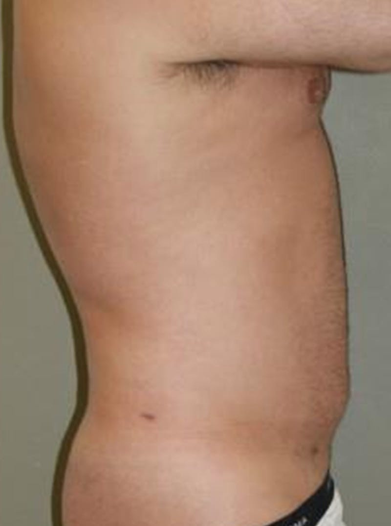 Liposuction Before & After Gallery - Patient 233390 - Image 4