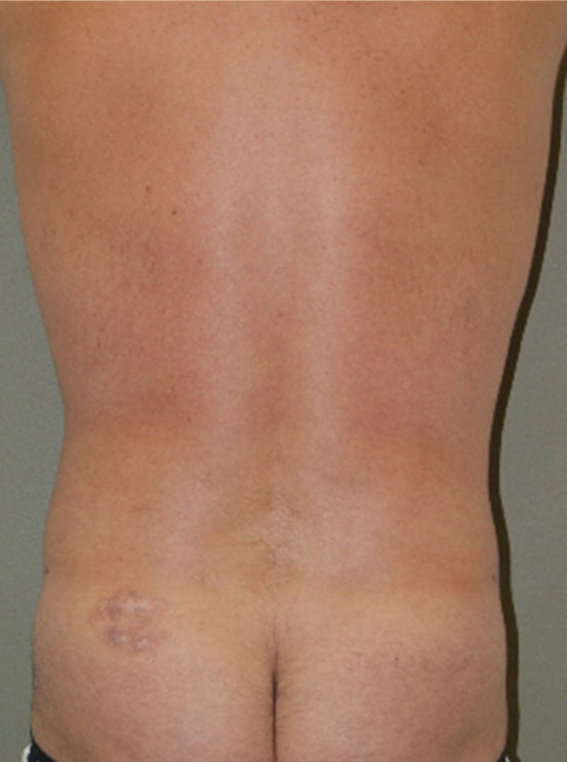 Liposuction Before & After Gallery - Patient 233390 - Image 6