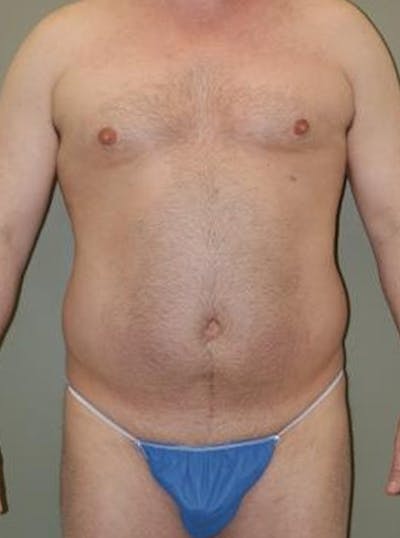 Liposuction Before & After Gallery - Patient 233390 - Image 1