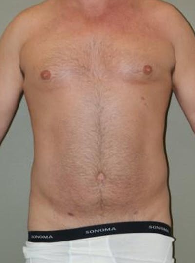 Liposuction Before & After Gallery - Patient 233390 - Image 2