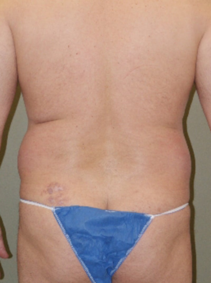 Liposuction Before & After Gallery - Patient 233390 - Image 5