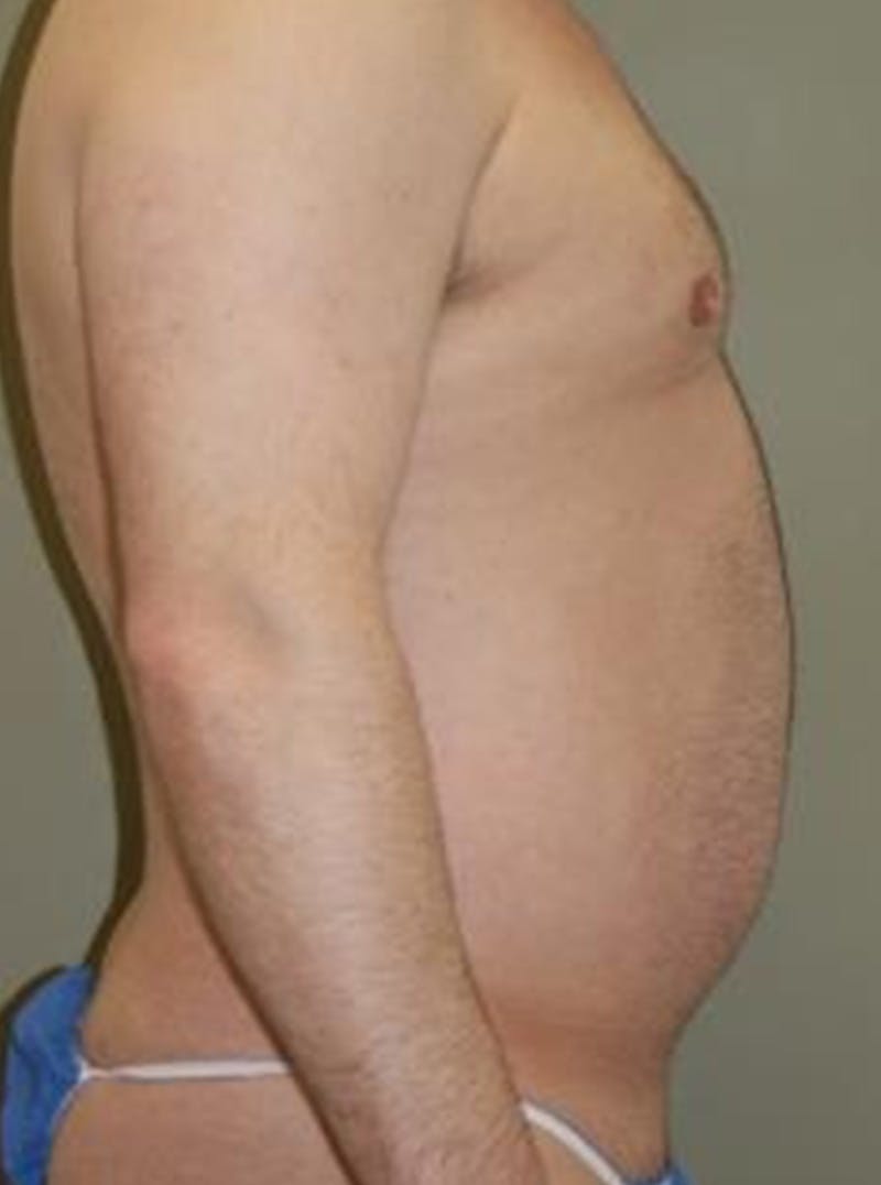 Liposuction Before & After Gallery - Patient 233390 - Image 3