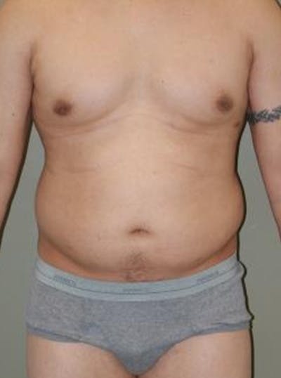 Liposuction Before & After Gallery - Patient 329916 - Image 1
