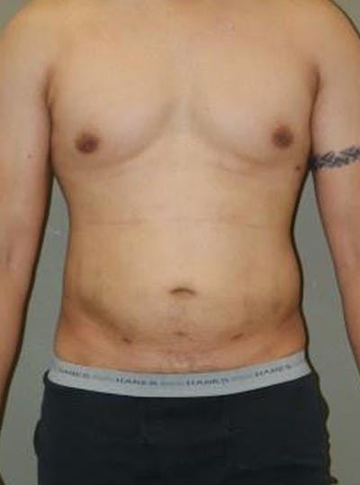 Liposuction Before & After Gallery - Patient 329916 - Image 2