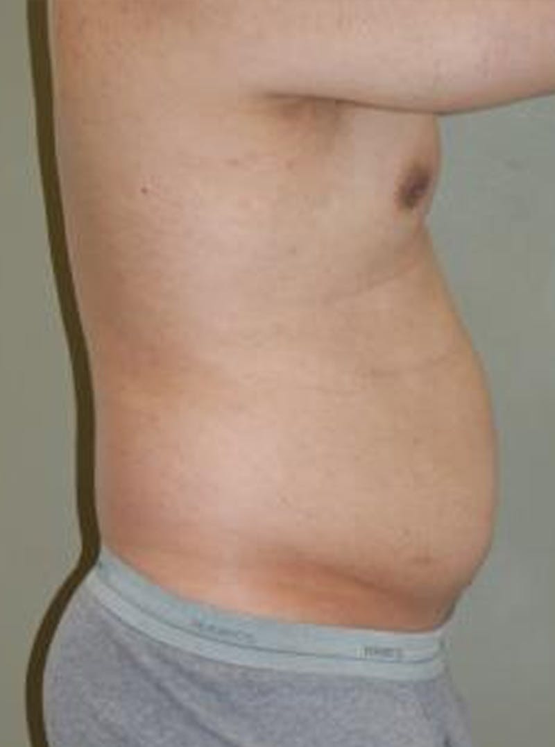 Liposuction Before & After Gallery - Patient 329916 - Image 3