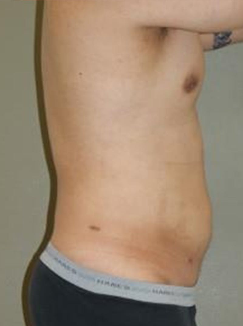 Liposuction Before & After Gallery - Patient 329916 - Image 4