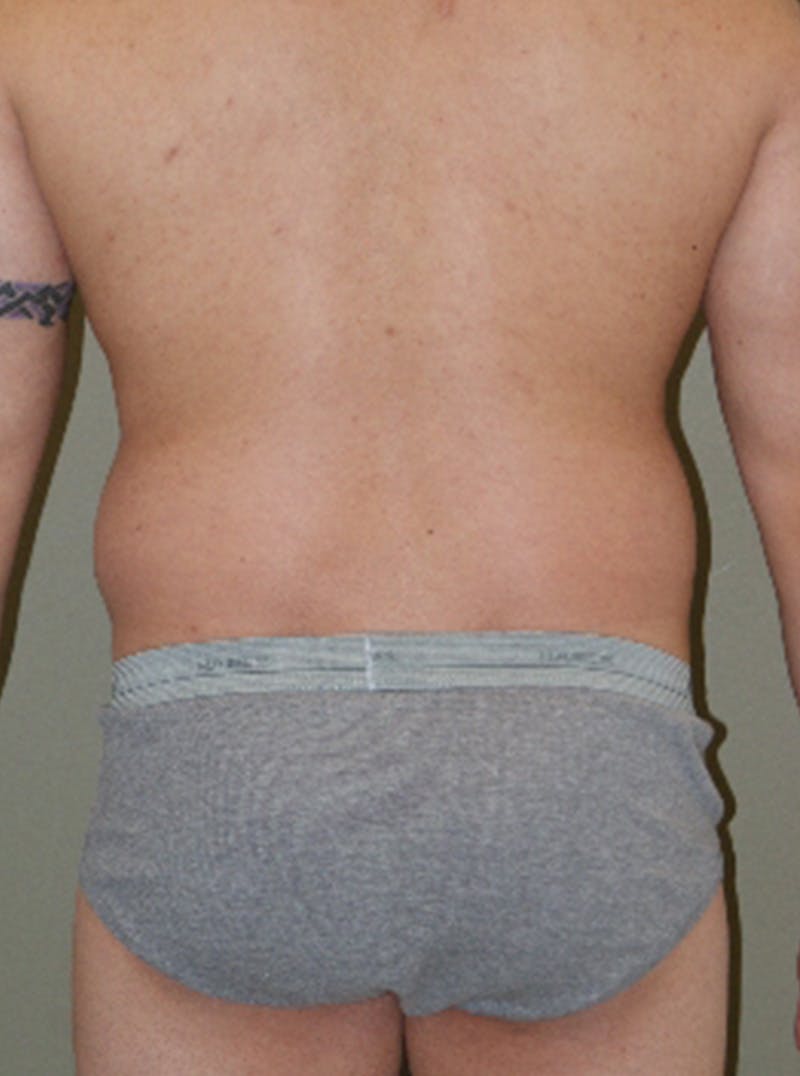 Liposuction Before & After Gallery - Patient 329916 - Image 5