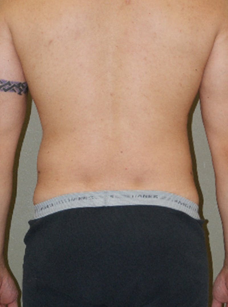 Liposuction Before & After Gallery - Patient 329916 - Image 6