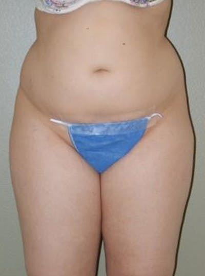 Liposuction Before & After Gallery - Patient 388957 - Image 1