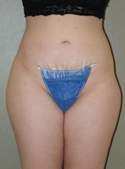 Liposuction Before & After Gallery - Patient 388957 - Image 2