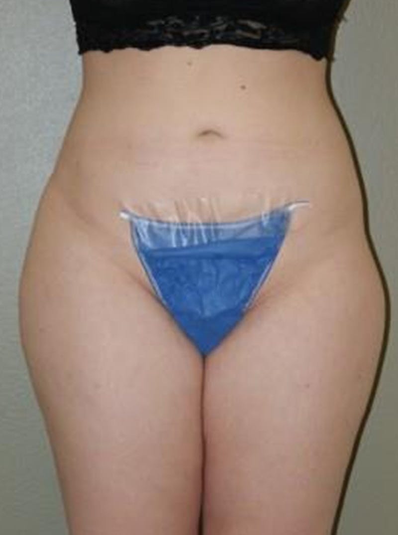 Liposuction Before & After Gallery - Patient 388957 - Image 2
