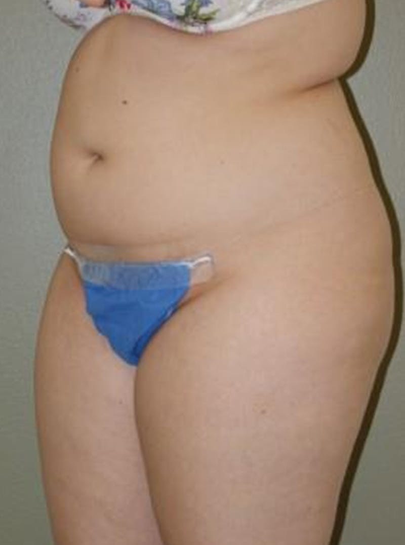 Liposuction Before & After Gallery - Patient 388957 - Image 3