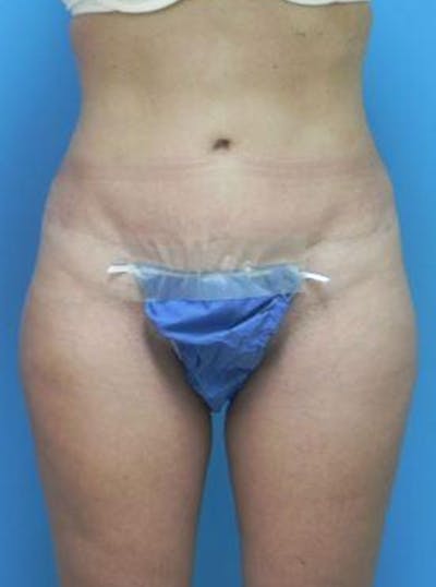 Liposuction Before & After Gallery - Patient 352727 - Image 1