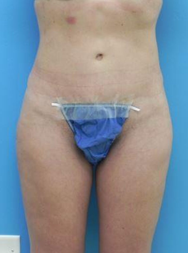 Liposuction Before & After Gallery - Patient 352727 - Image 2