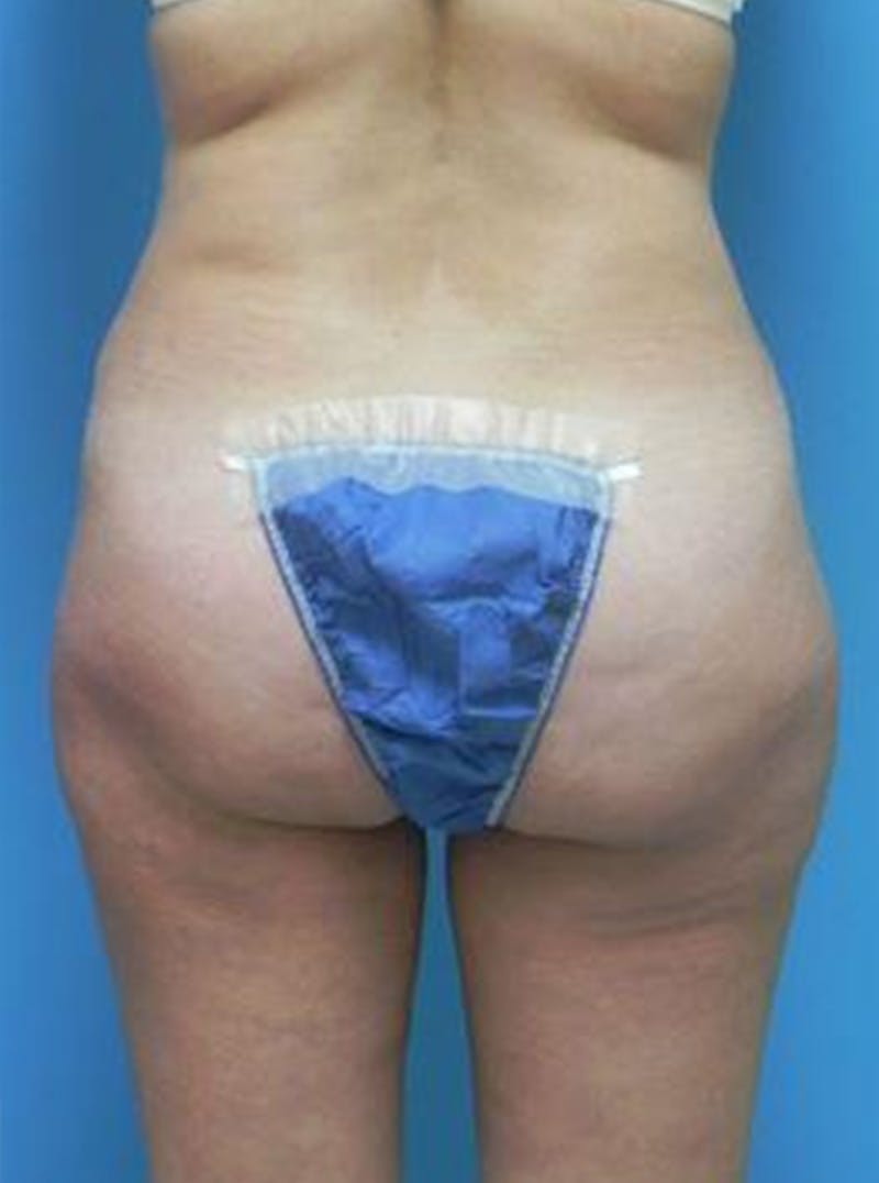 Liposuction Before & After Gallery - Patient 352727 - Image 3