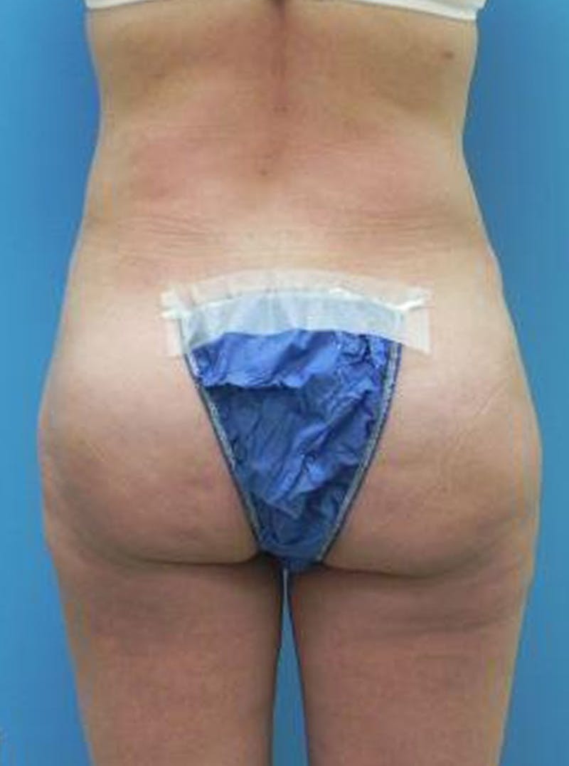 Liposuction Before & After Gallery - Patient 352727 - Image 4