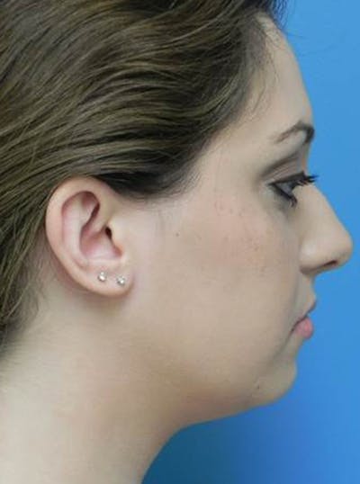 Liposuction Before & After Gallery - Patient 169870 - Image 1