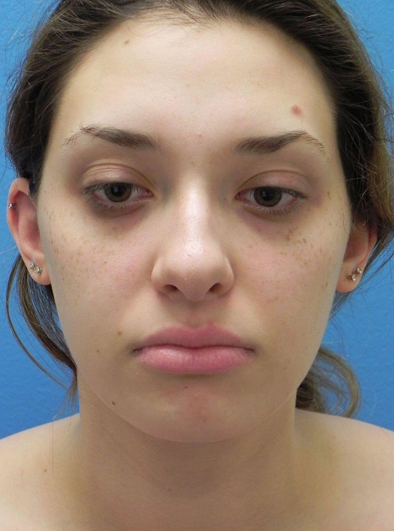 Liposuction Before & After Gallery - Patient 169870 - Image 4