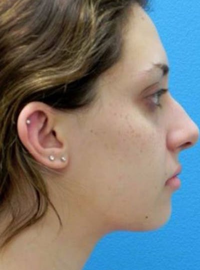 Liposuction Before & After Gallery - Patient 169870 - Image 2