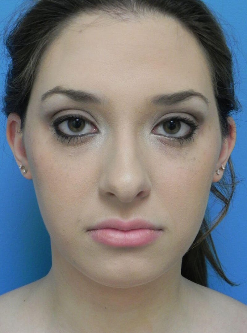 Liposuction Before & After Gallery - Patient 169870 - Image 3