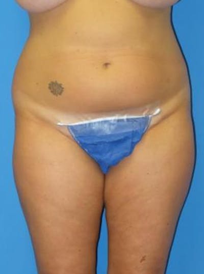Liposuction Before & After Gallery - Patient 284407 - Image 1