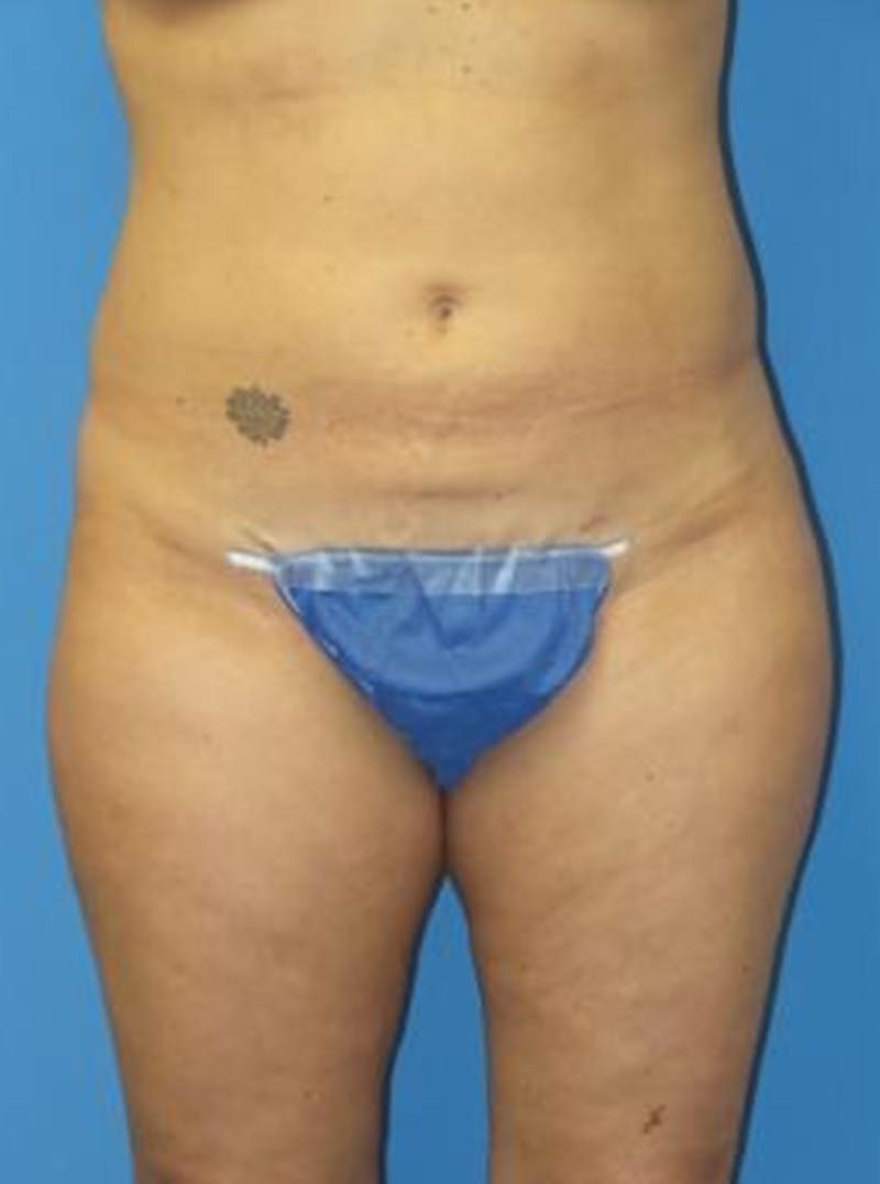 Liposuction Before & After Gallery - Patient 284407 - Image 2