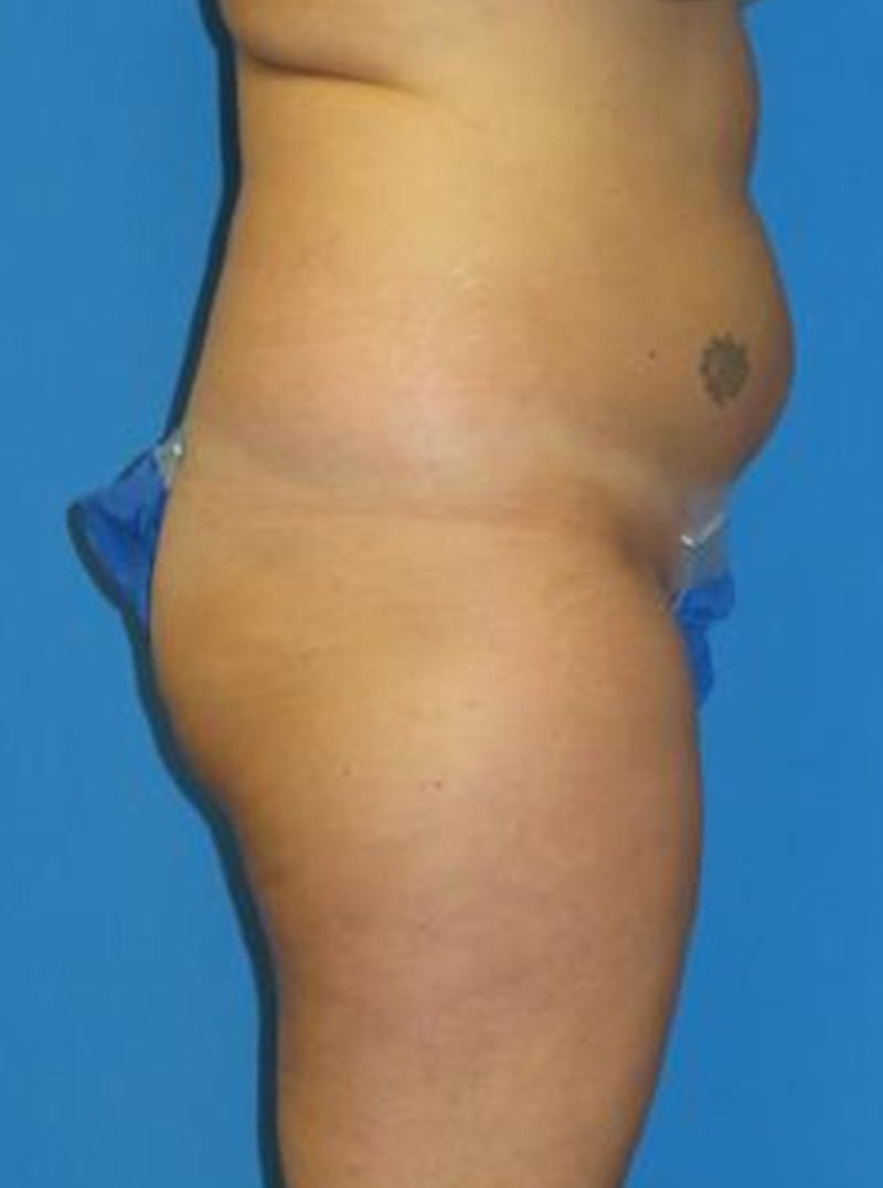 Liposuction Before & After Gallery - Patient 284407 - Image 3