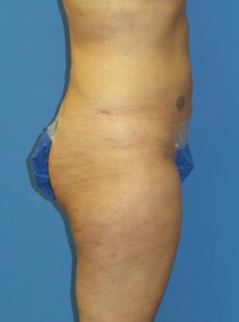 Liposuction Before & After Gallery - Patient 284407 - Image 4