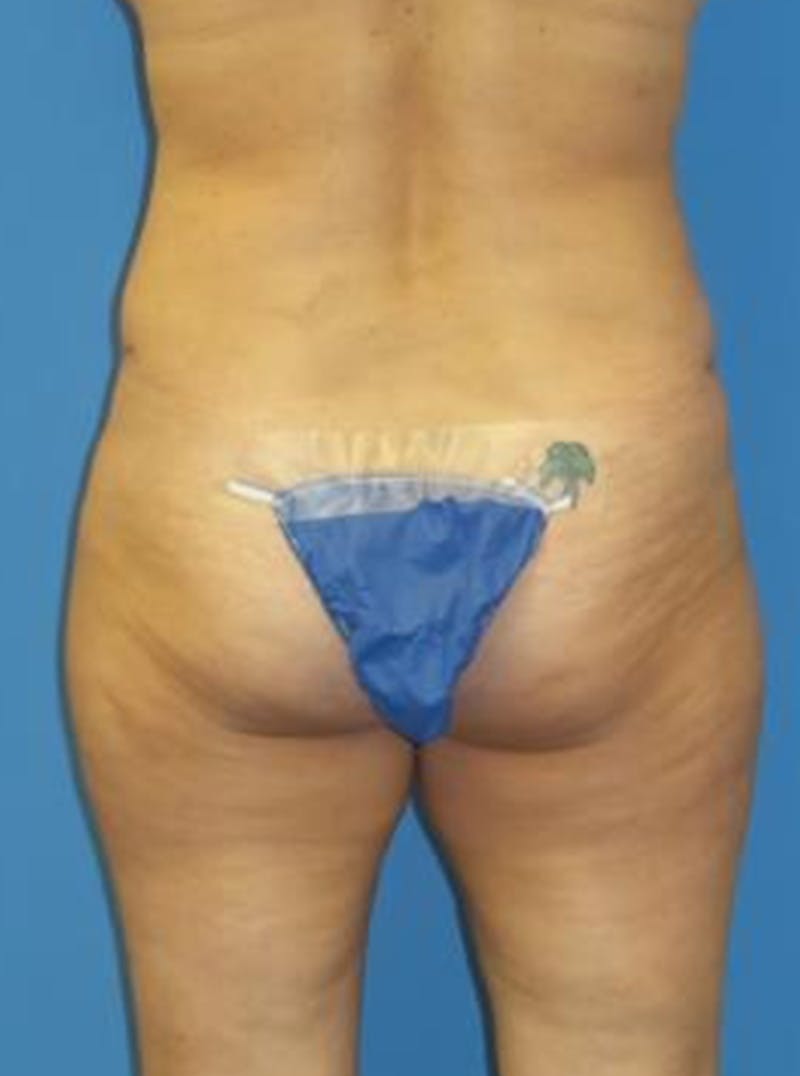 Liposuction Before & After Gallery - Patient 284407 - Image 6