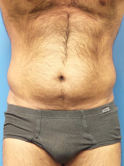 Liposuction Before & After Gallery - Patient 399784 - Image 1