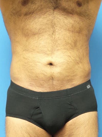 Liposuction Before & After Gallery - Patient 399784 - Image 2