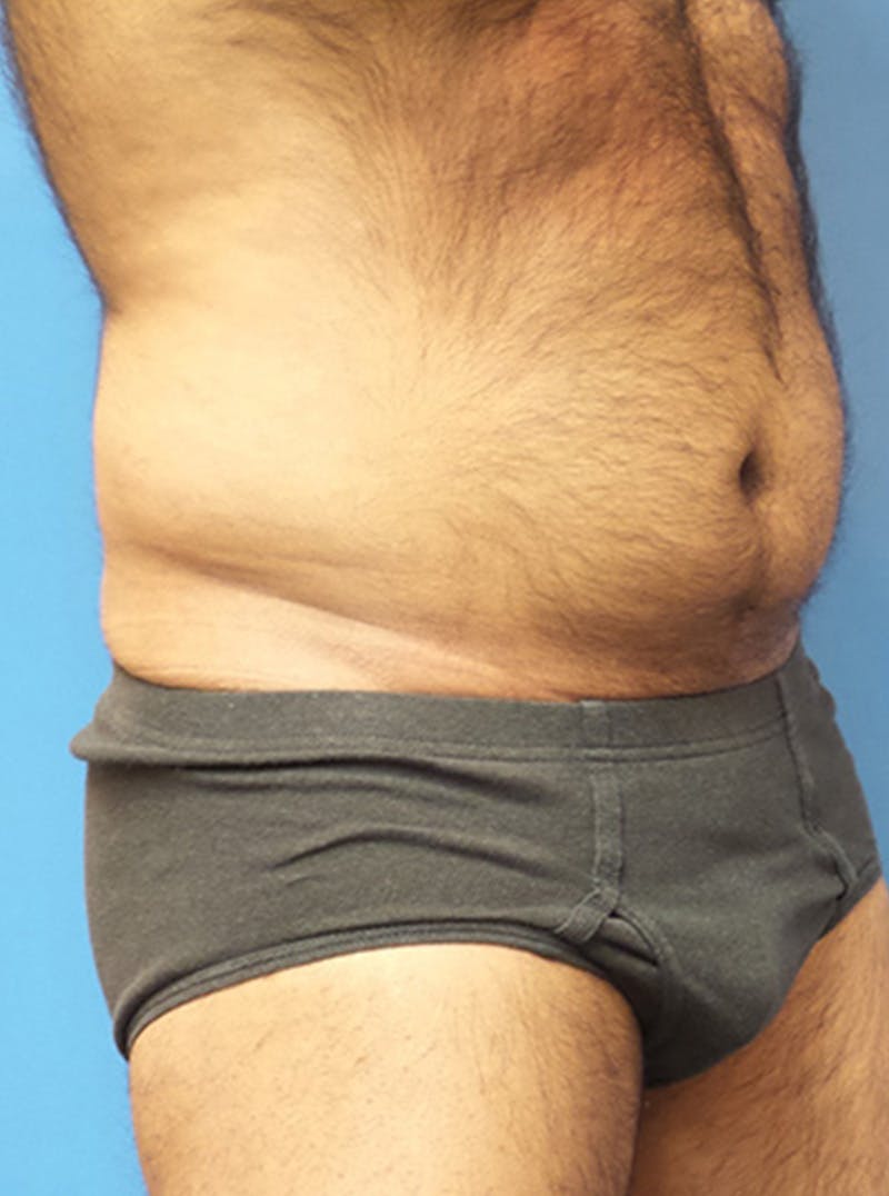 Liposuction Before & After Gallery - Patient 399784 - Image 3