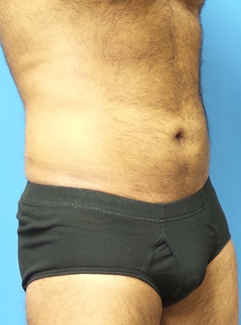 Liposuction Before & After Gallery - Patient 399784 - Image 4