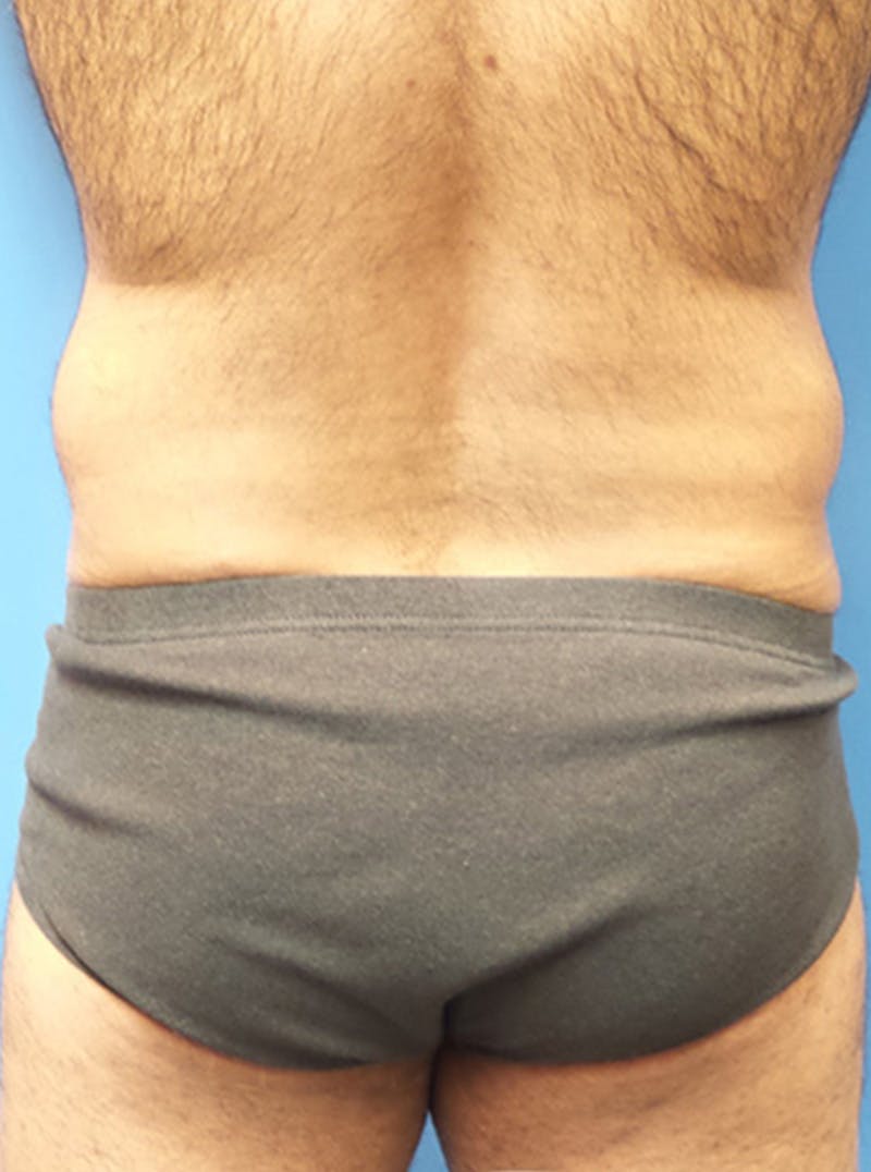 Liposuction Before & After Gallery - Patient 399784 - Image 5