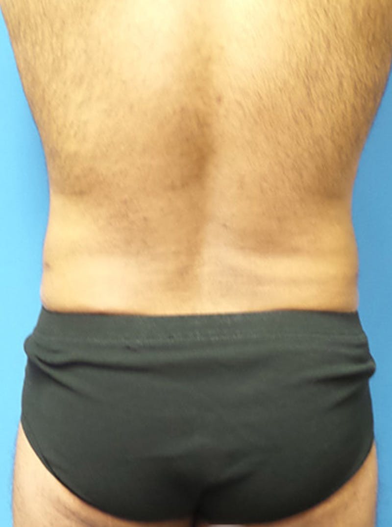 Liposuction Before & After Gallery - Patient 399784 - Image 6