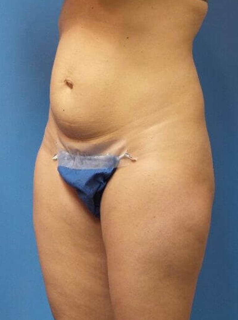 Liposuction Before & After Gallery - Patient 818846 - Image 3