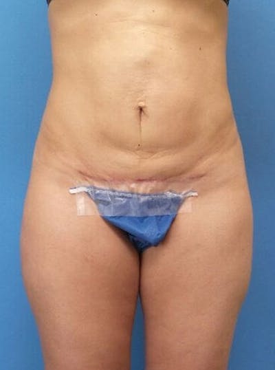 Liposuction Before & After Gallery - Patient 818846 - Image 2