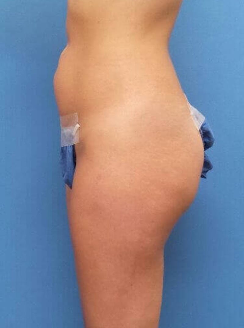 Liposuction Before & After Gallery - Patient 679370 - Image 3