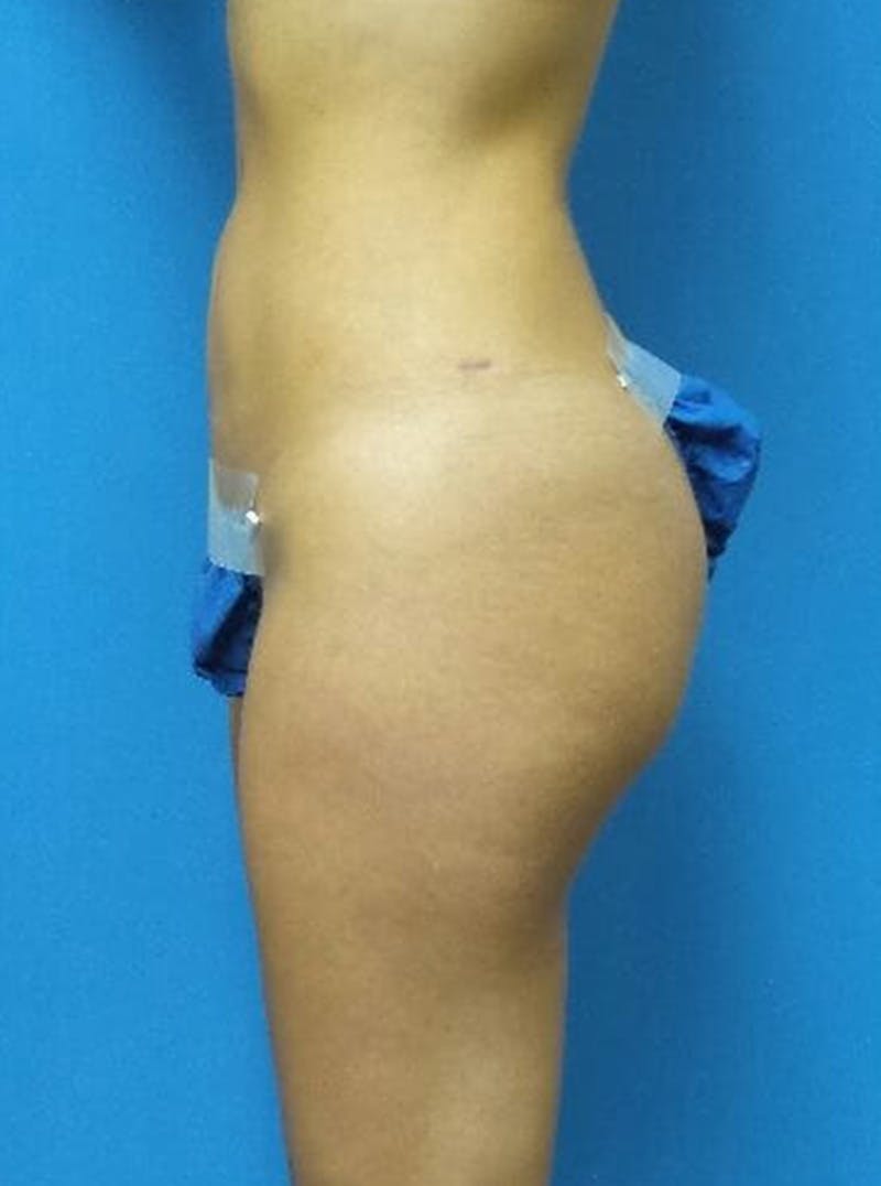 Liposuction Before & After Gallery - Patient 679370 - Image 4